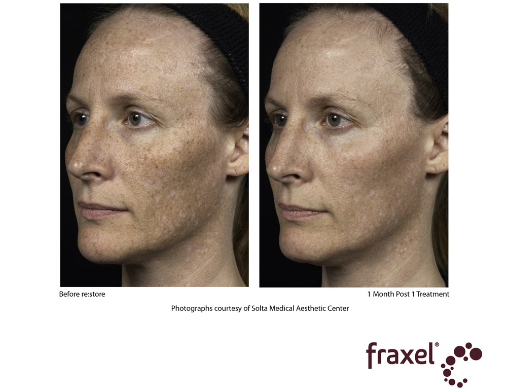 0279-Fraxel_1927_3_HiRes